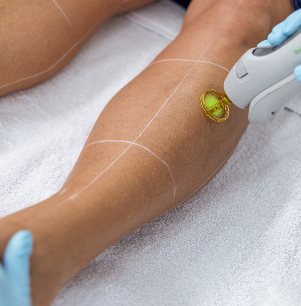 Jambes d’une femme montrant une peau lisse après épilation laser, main passant sur la jambe gauche.