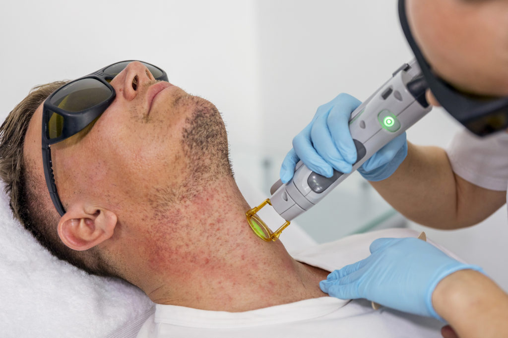 Un homme subit une session d'épilation laser au niveau de la nuque à la clinique Dr Djoon à Genève.