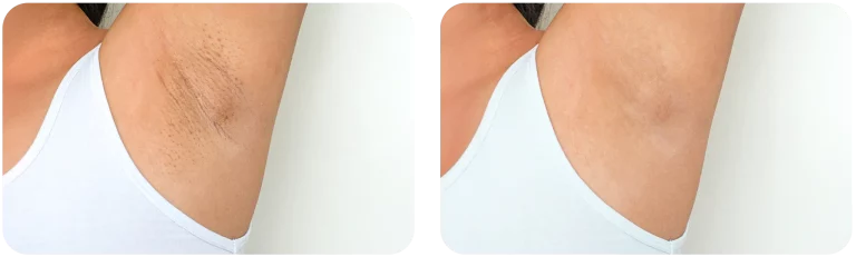 epilation-laser-avant-apres