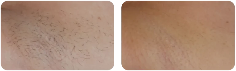 epilation-laser-aisselle-avant-apres