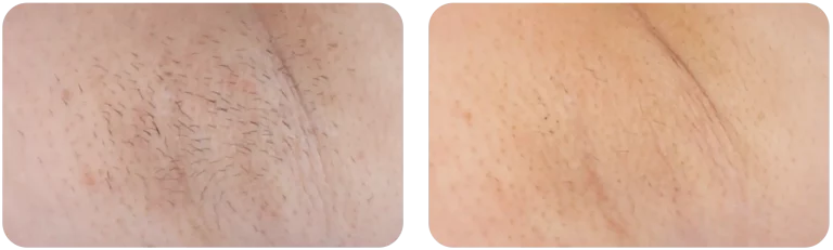 epilation-laser-aisselle-avis