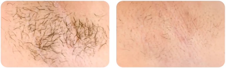 epilation-laser-geneve