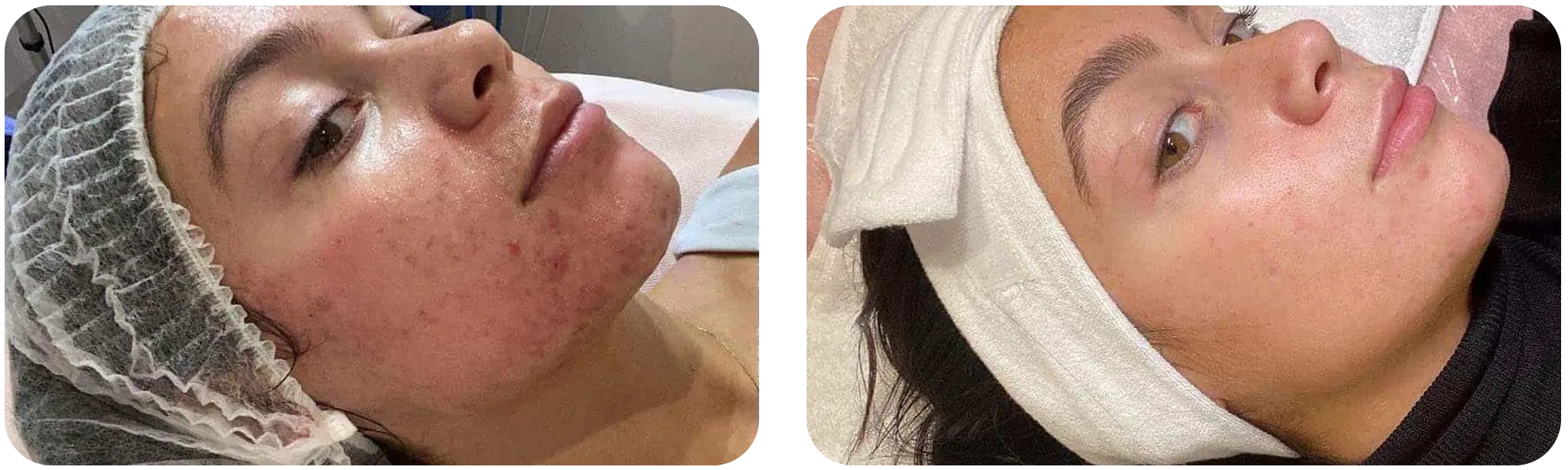 Avant Apres -hydrafacial acne