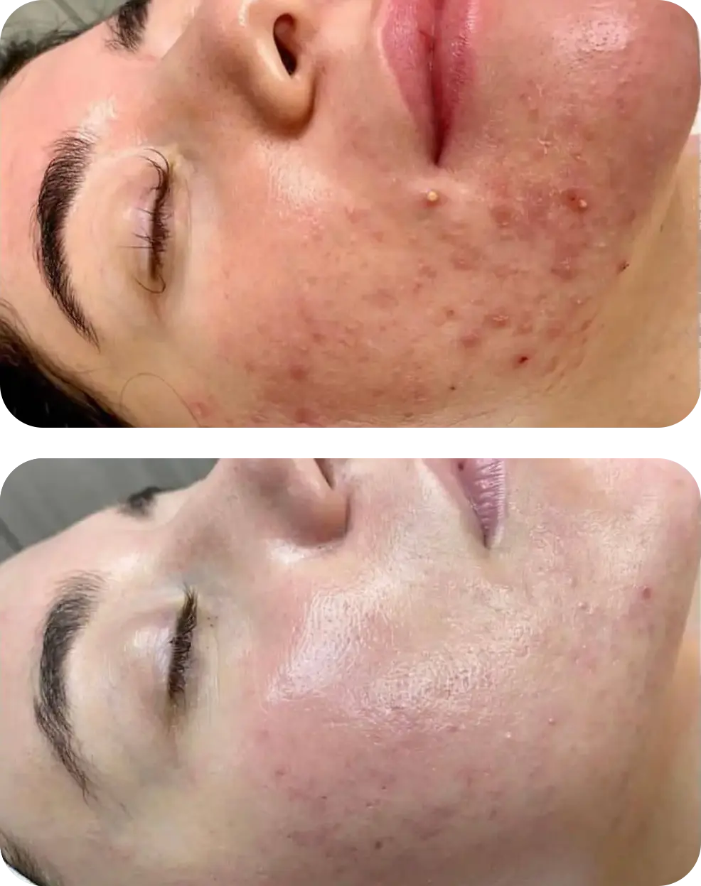 acne avant apres - hydrafacial geneve mobile