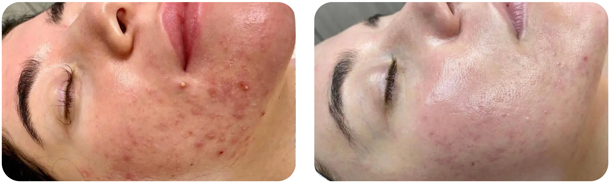 acne avant apres - hydrafacial geneve