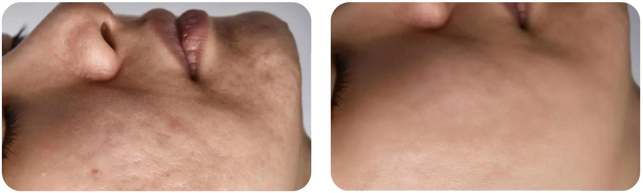 dermapen avant après copie