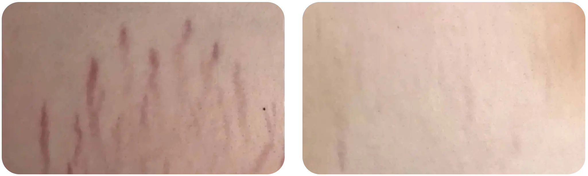 dermapen avant après geneve