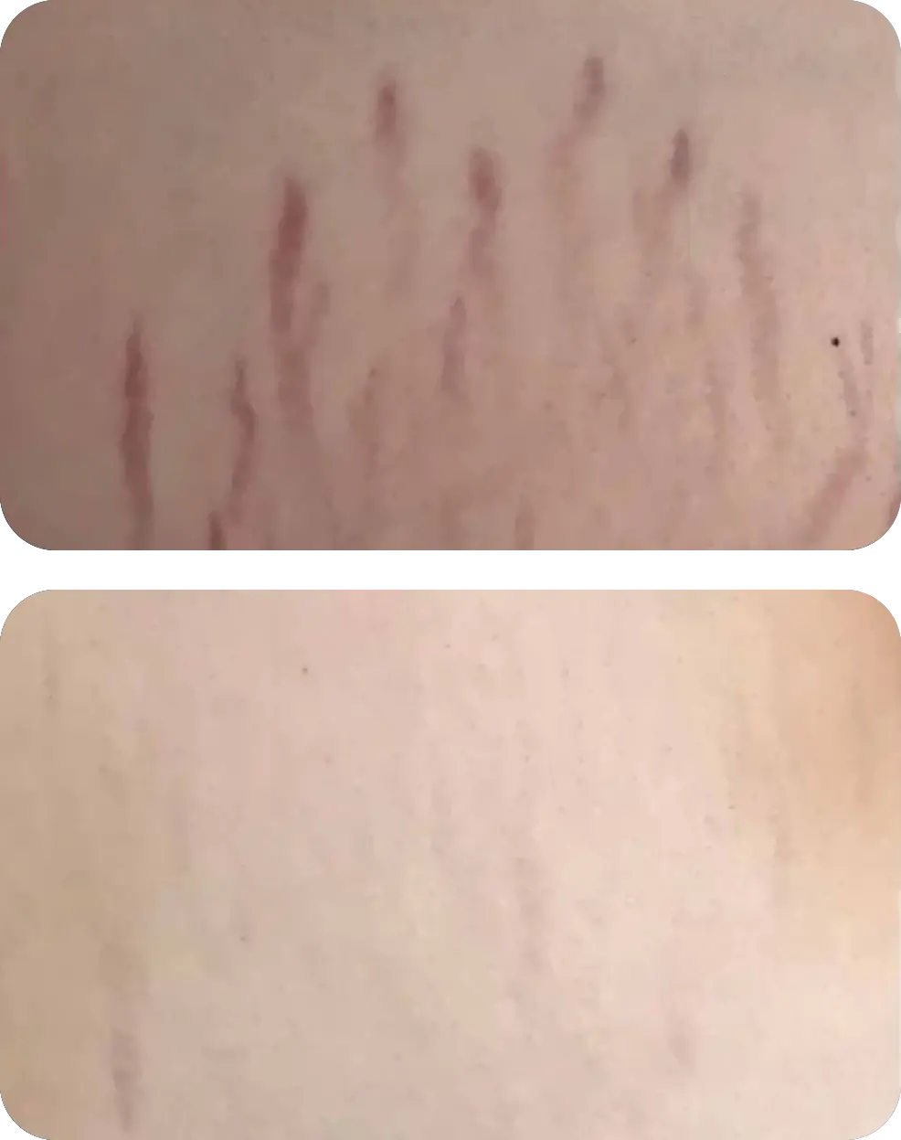 dermapen avant après mobile