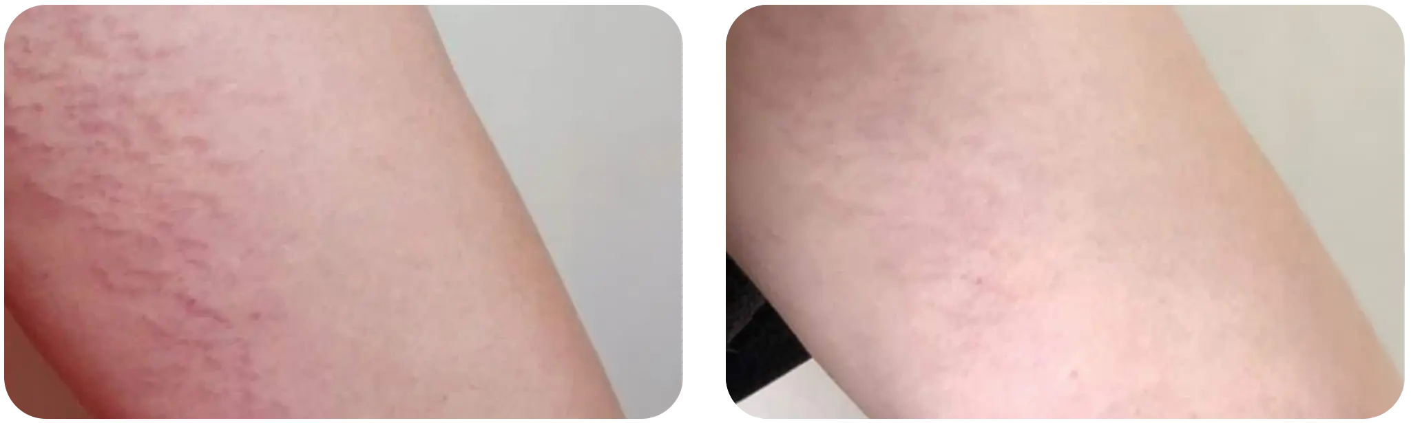 dermapen geneve avant après