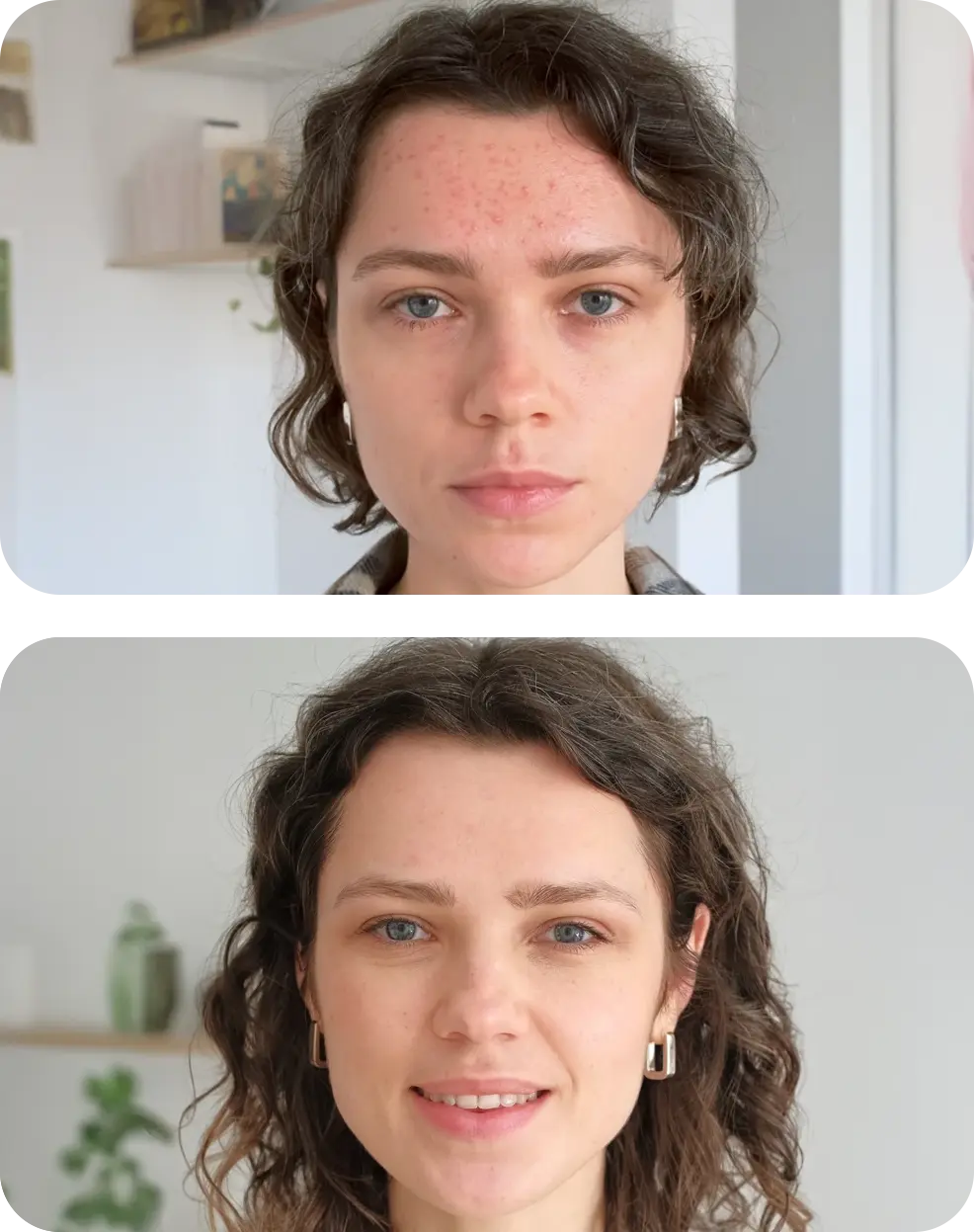 hydrafacial avant apres boutons acne - mobile