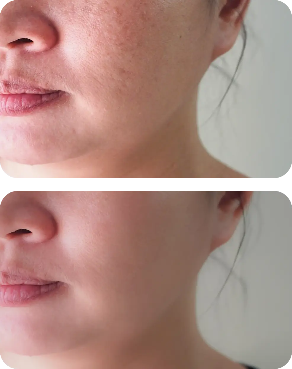 hydrafacial avant apres pores dilates - mobile