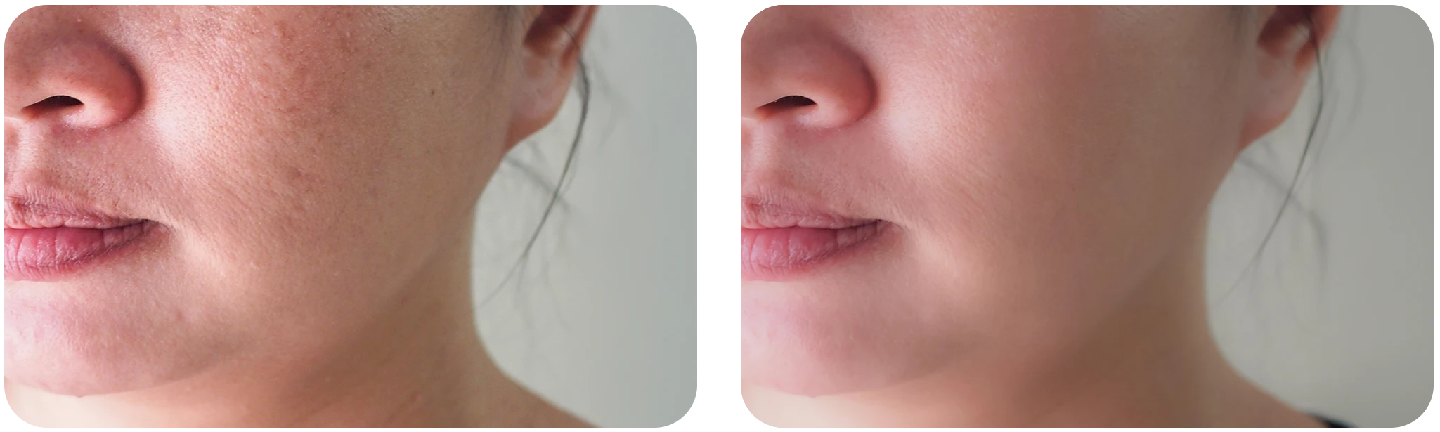 hydrafacial avant apres pores dilates