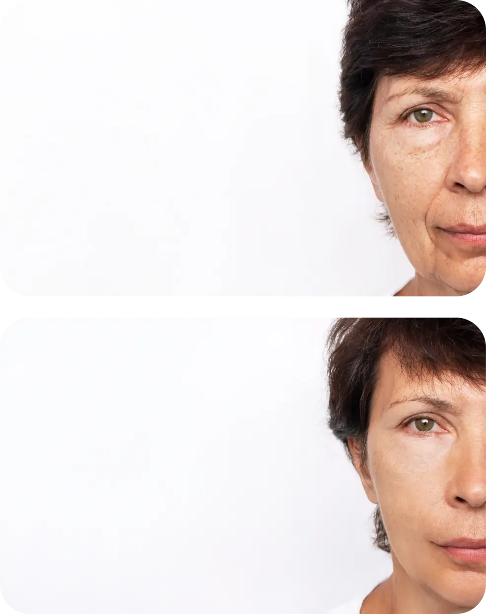 hydrafacial avant apres rides - mobile