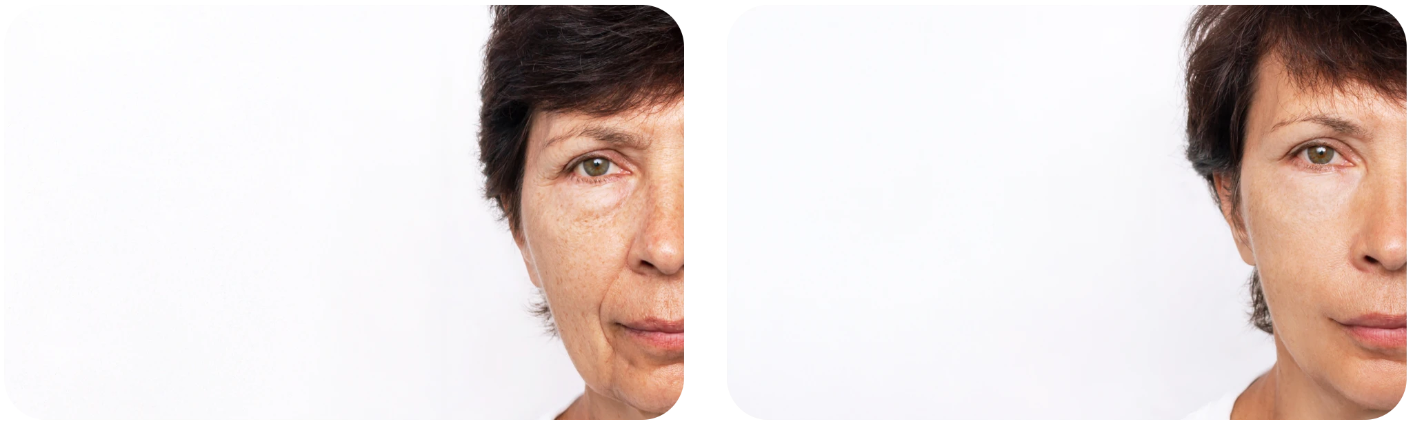 hydrafacial avant apres rides
