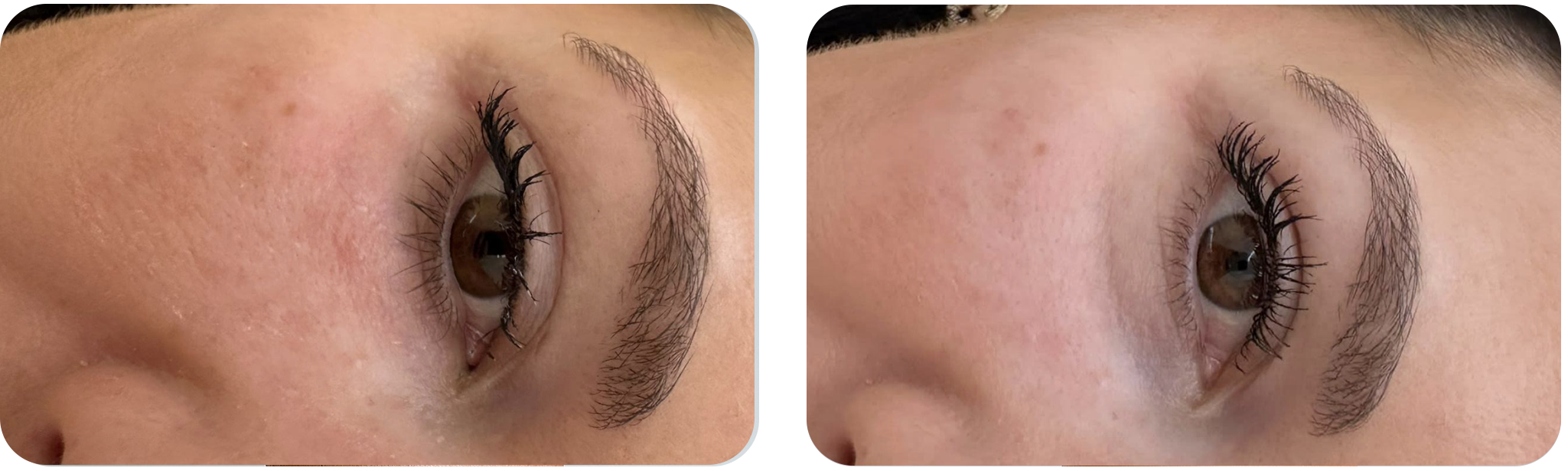 hydrafacial-resultat