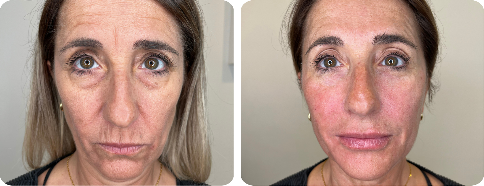 Lifting Effect Avant/Après
