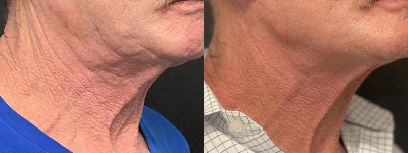 Comparaison avant/après du traitement Morpheus8 sur le visage. Les résultats montrent une peau visiblement plus lisse, plus ferme et rajeunie.
